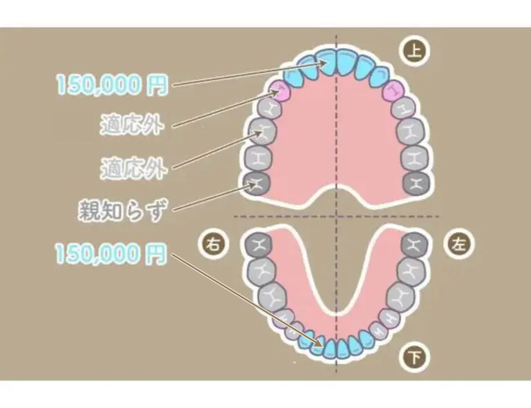 ダイレクトブリッジの部位と料金画像