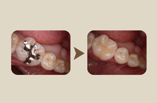 虫歯や入れ歯等の治療例 （症例）