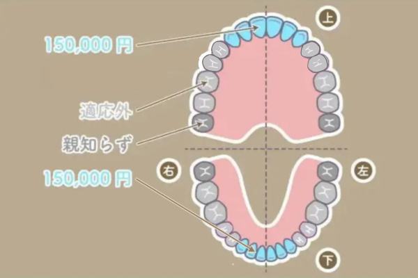 ダイレクトブリッジの部位と料金の画像